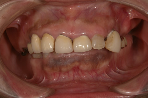 入れ歯症例3　治療前