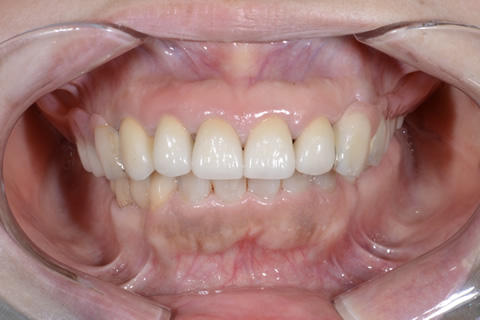 入れ歯症例3　治療後